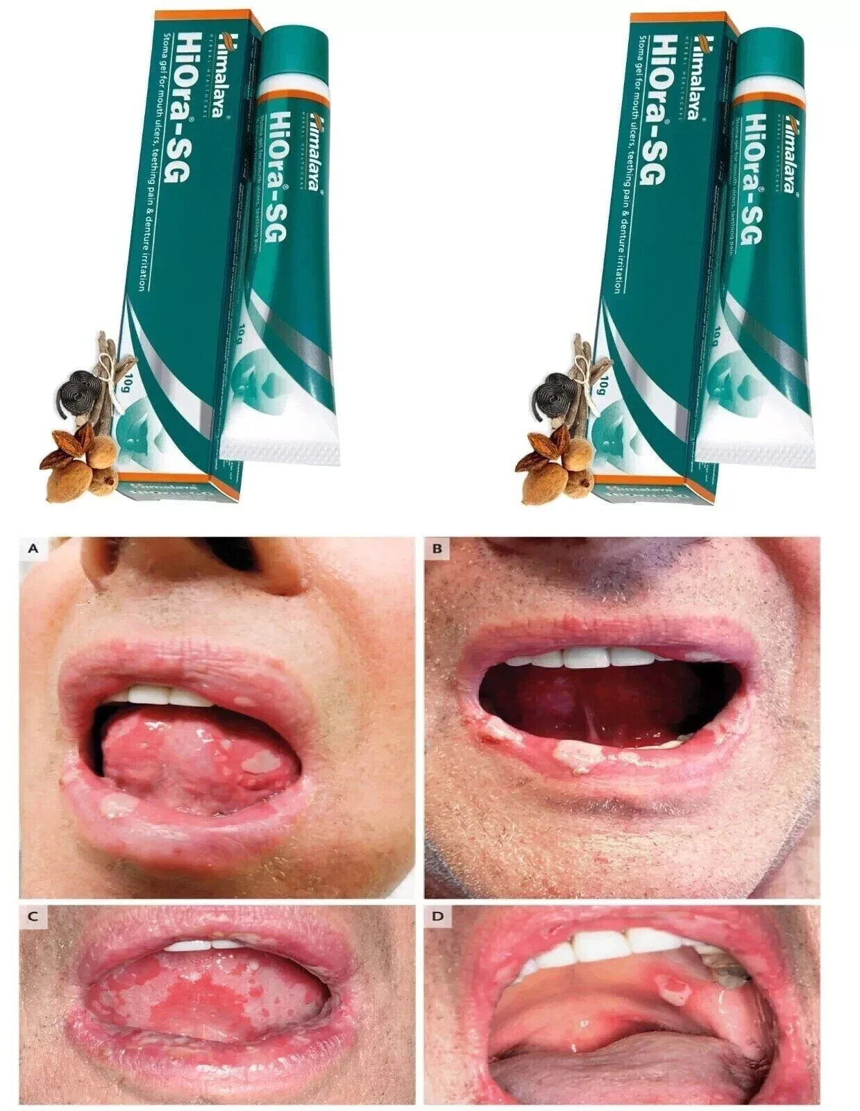Himalaya Hiora-SG Gel For Mouth Ulcers Very Fast Free Delivery 10g X 2 Ex. 04-28