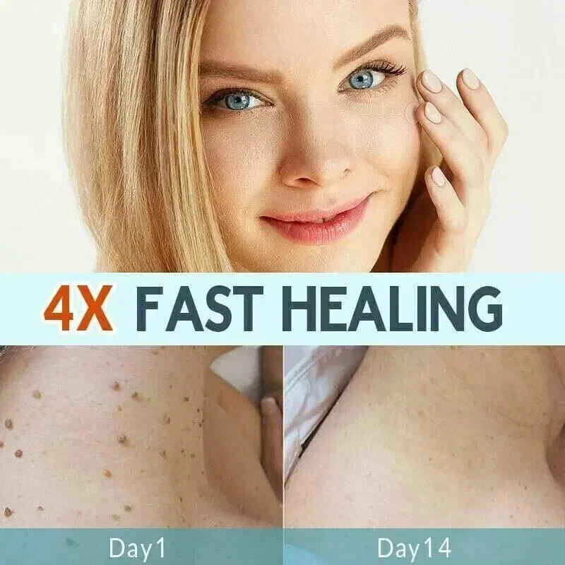 NEW SKIN TAG REMOVER CREAM SAFE FAST WART REMOVAL MOLE ACNE PIMPLE PATCH SPOT UK