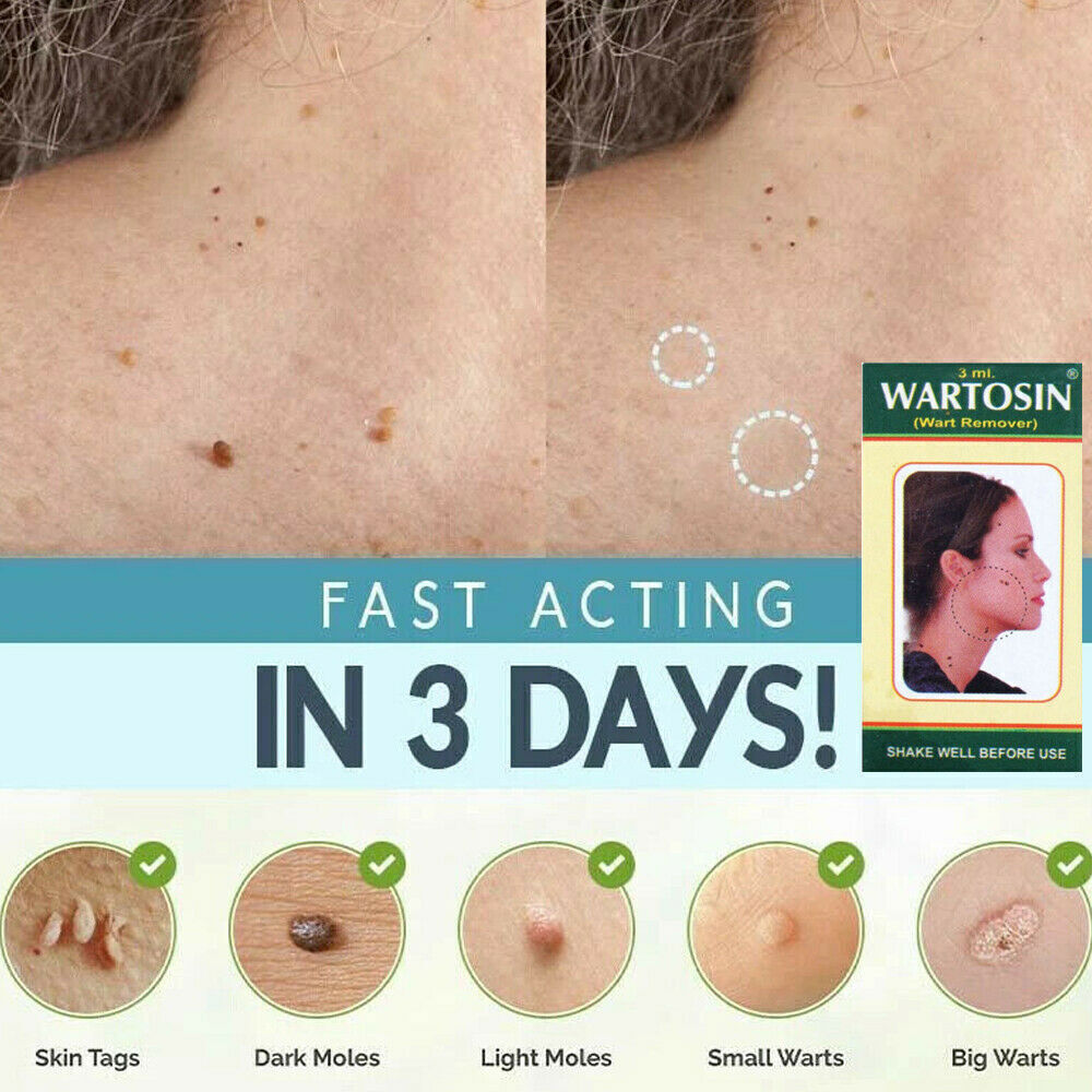 NEW SKIN TAG REMOVER CREAM SAFE FAST WART REMOVAL MOLE ACNE PIMPLE PATCH SPOT US